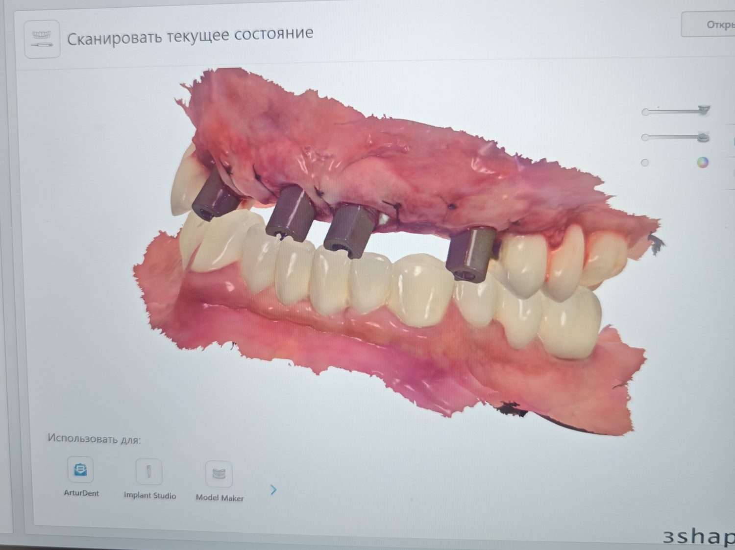 Цифровой скан в 3Shape